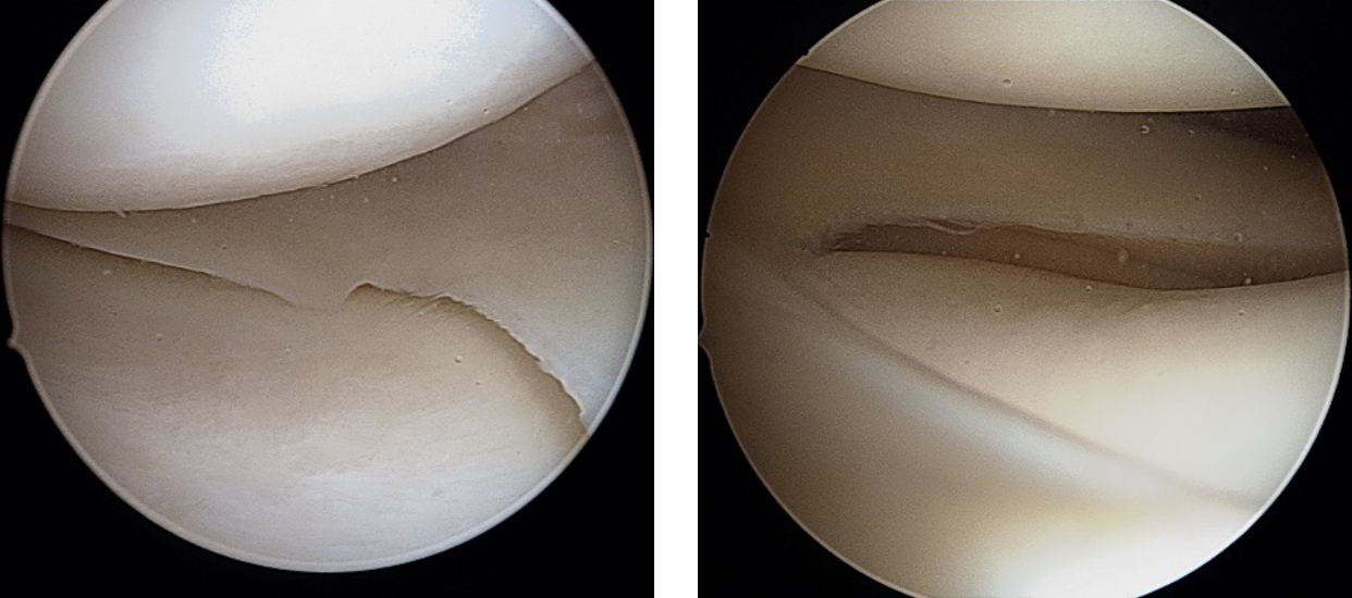 Tratamento da rotura meniscal - exemplo meniscos
