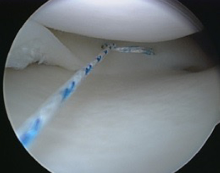 Imagem da sutura meniscal all inside do corno posterior do menisco