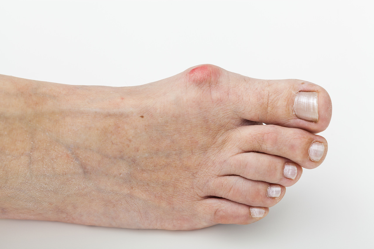 Joanetes: inflamação.