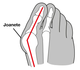 Joanetes: o que é?