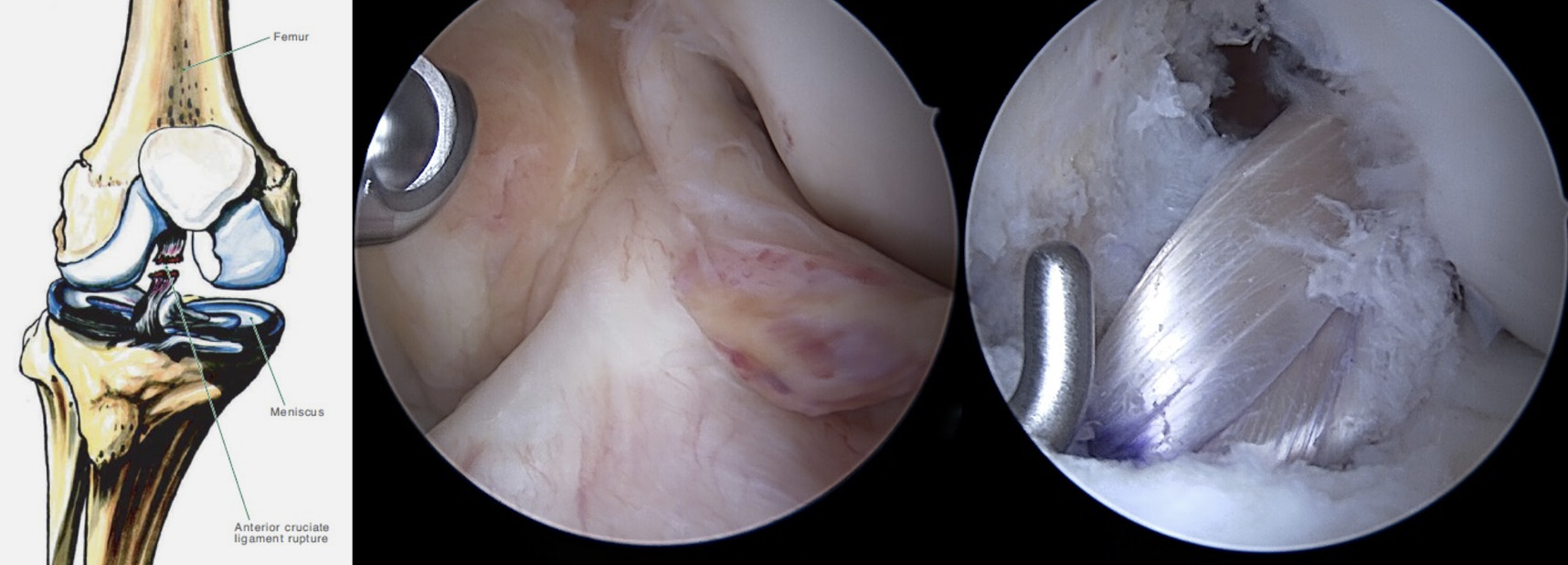 Dr. Tiago Frada - Imagem ilustrativa do menisco