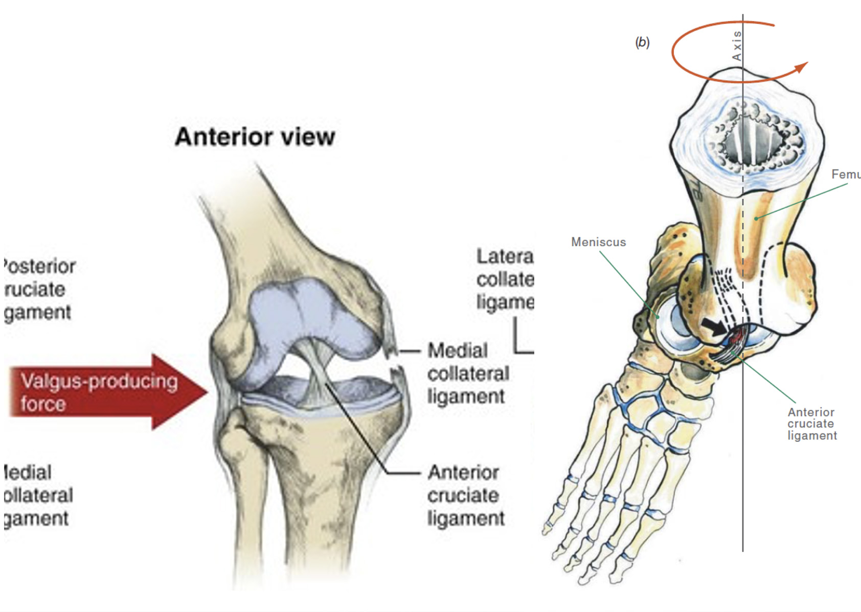 Dr. Tiago Frada - Mecanismo habitual de lesão do LCA