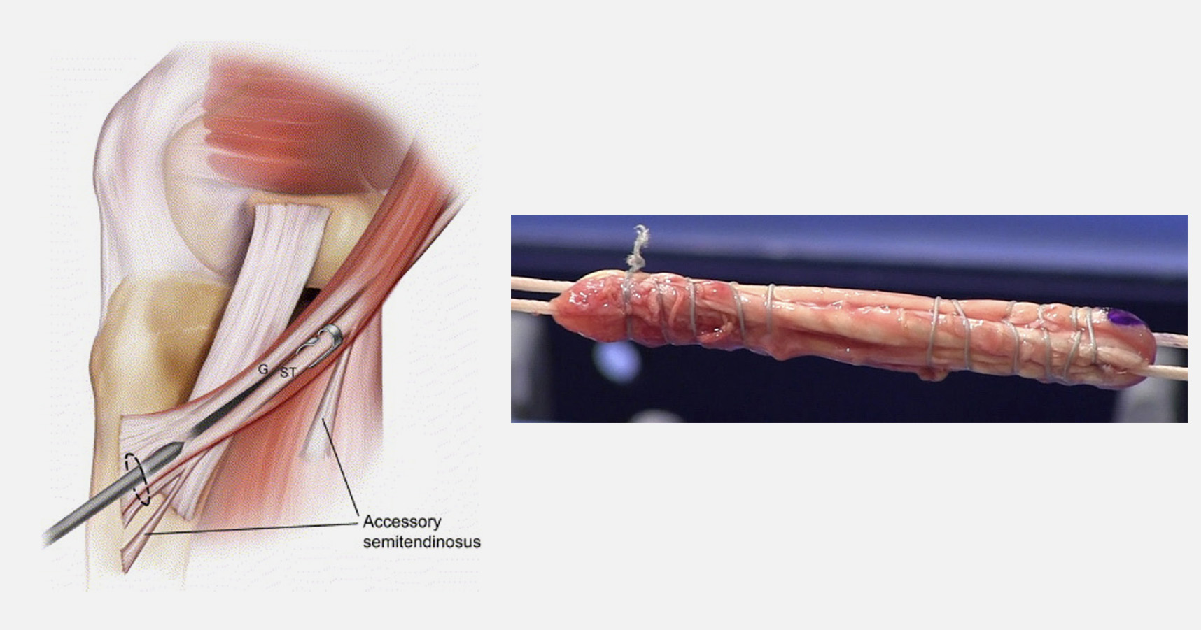 Enxerto Tendão - Isquiotibiais