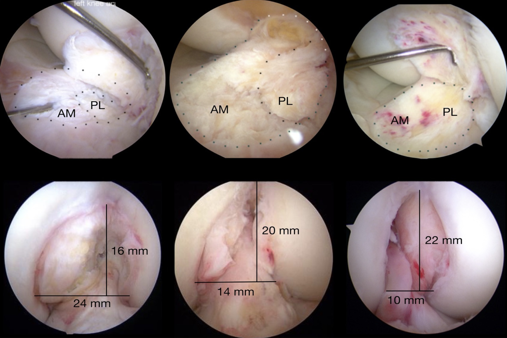 Imagens de 3 anatomias distintas da inserção tibial do LCA e estrutura da incisura intercondiliana