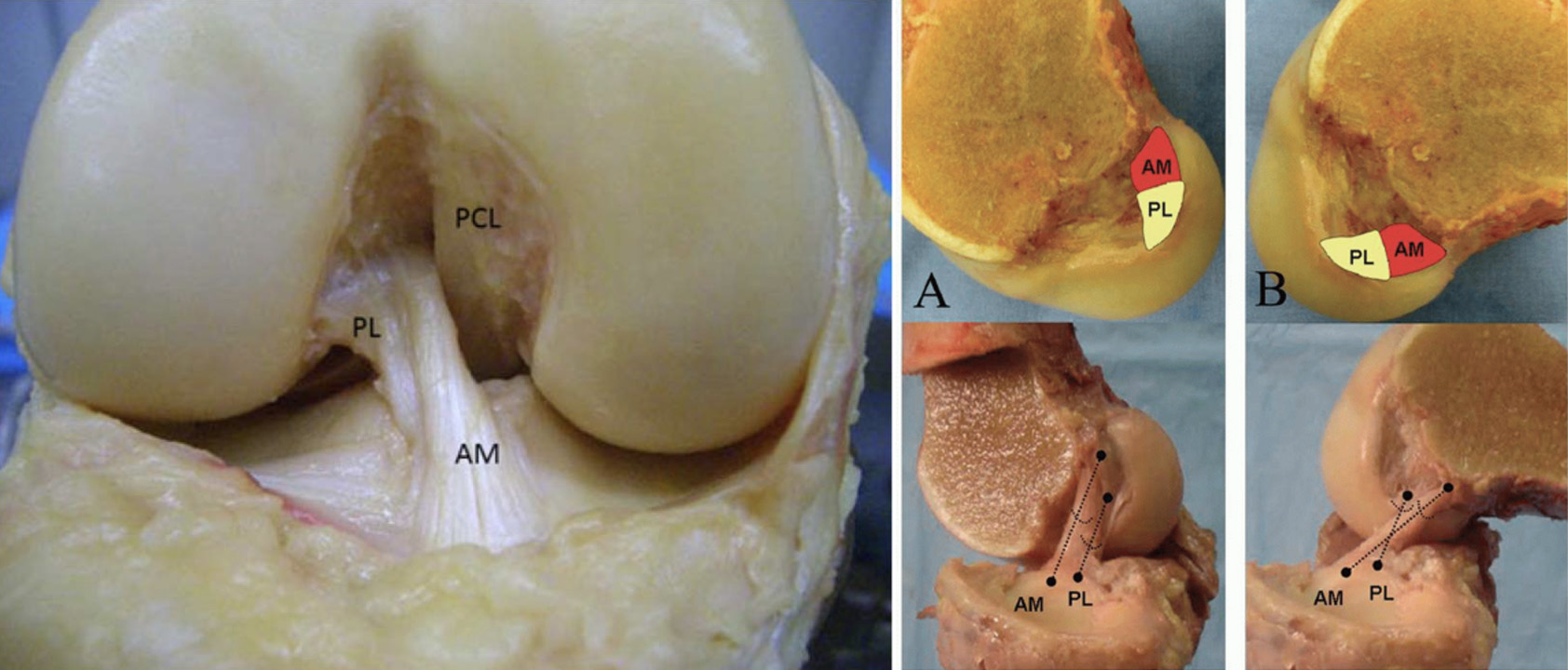 Anatomia do LCA. Feixes AnteroMedial e PosteroLateral.