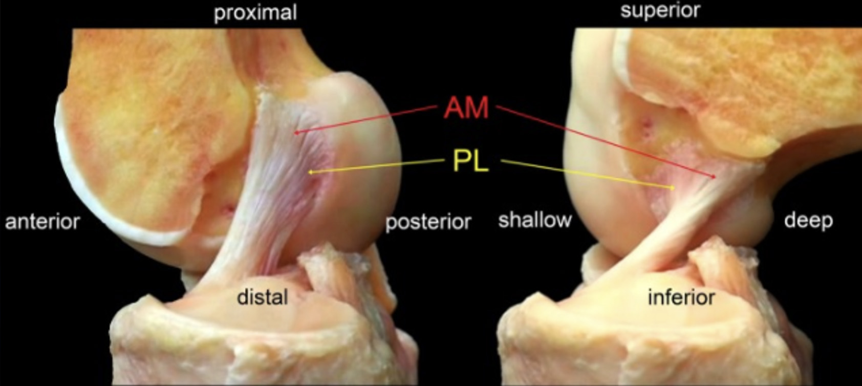 Imagem sagital do LCA