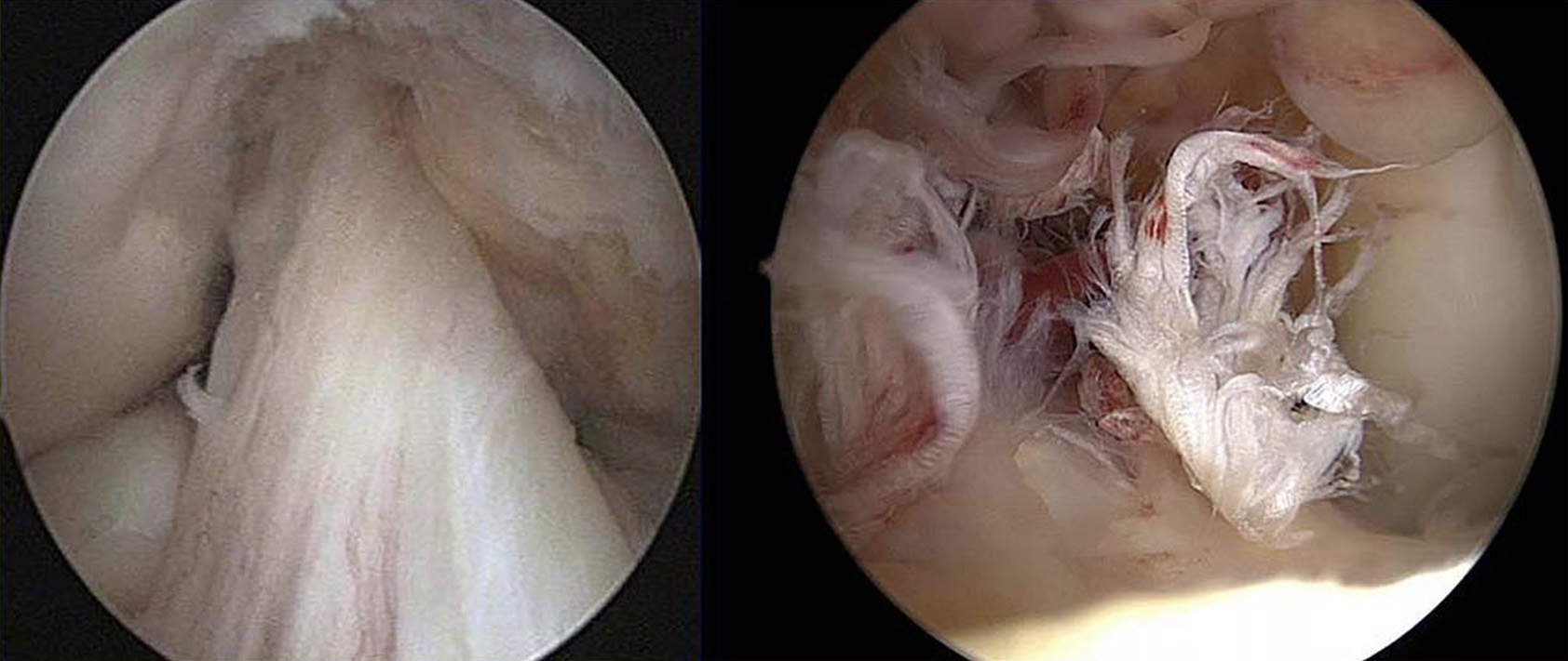 LCA intacto; rotura do LCA