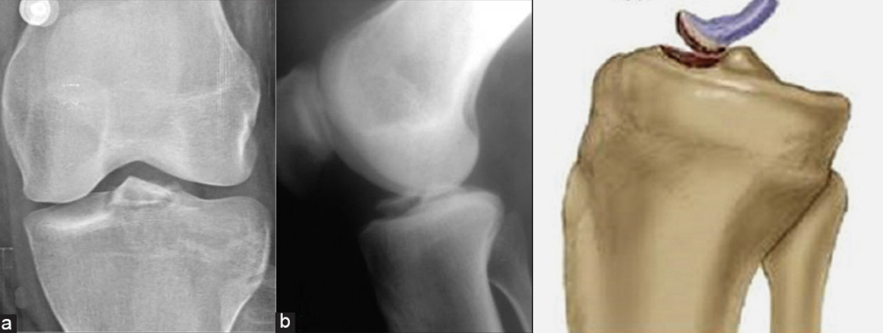 Avulsão óssea da inserção distal do LCA, imagem de Rx e representação gráfica