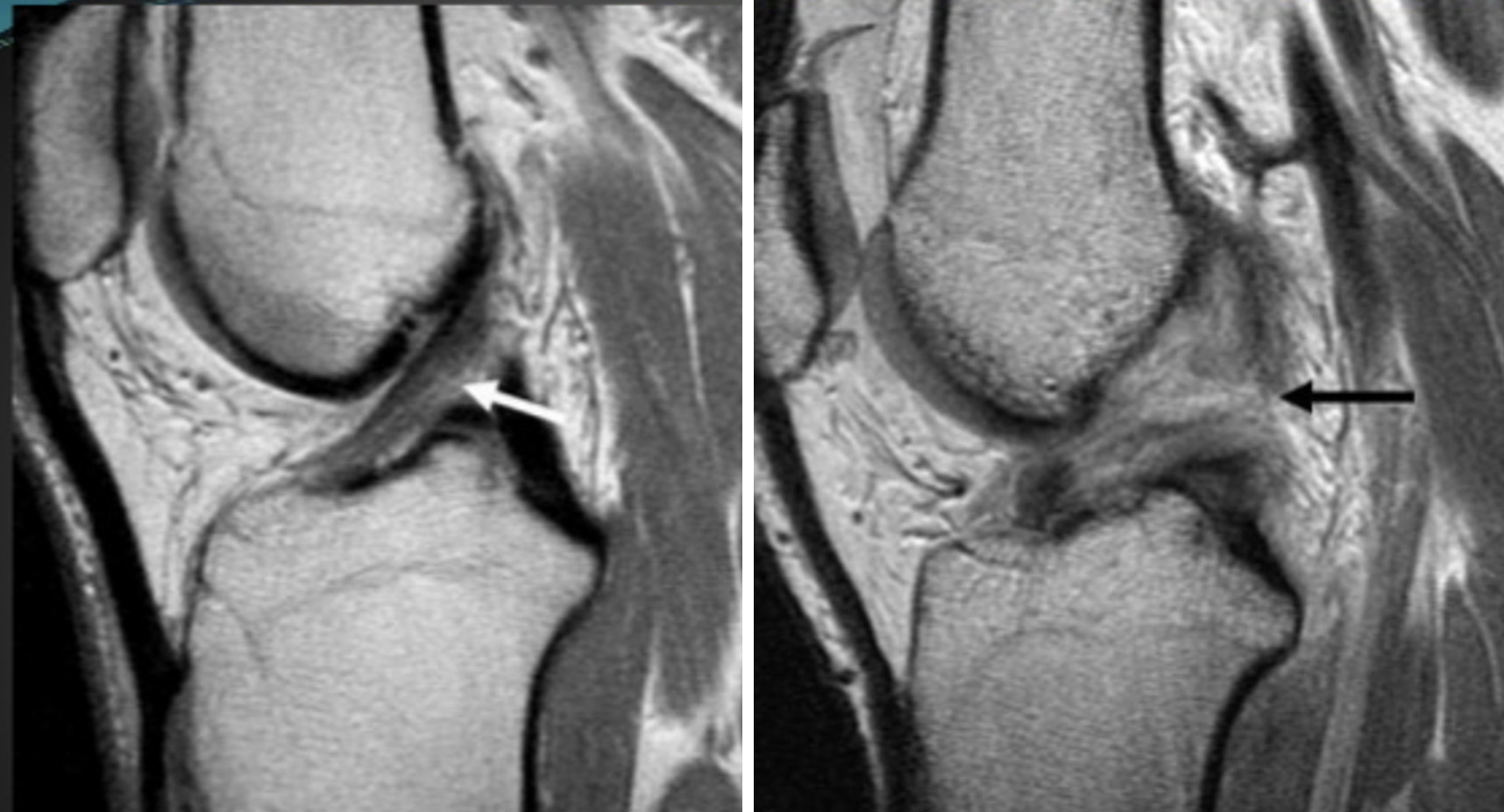 Imagem de ressonância magnética. Seta à esquerda com LCA intacto. Imagem à direita com rotura do LCA.