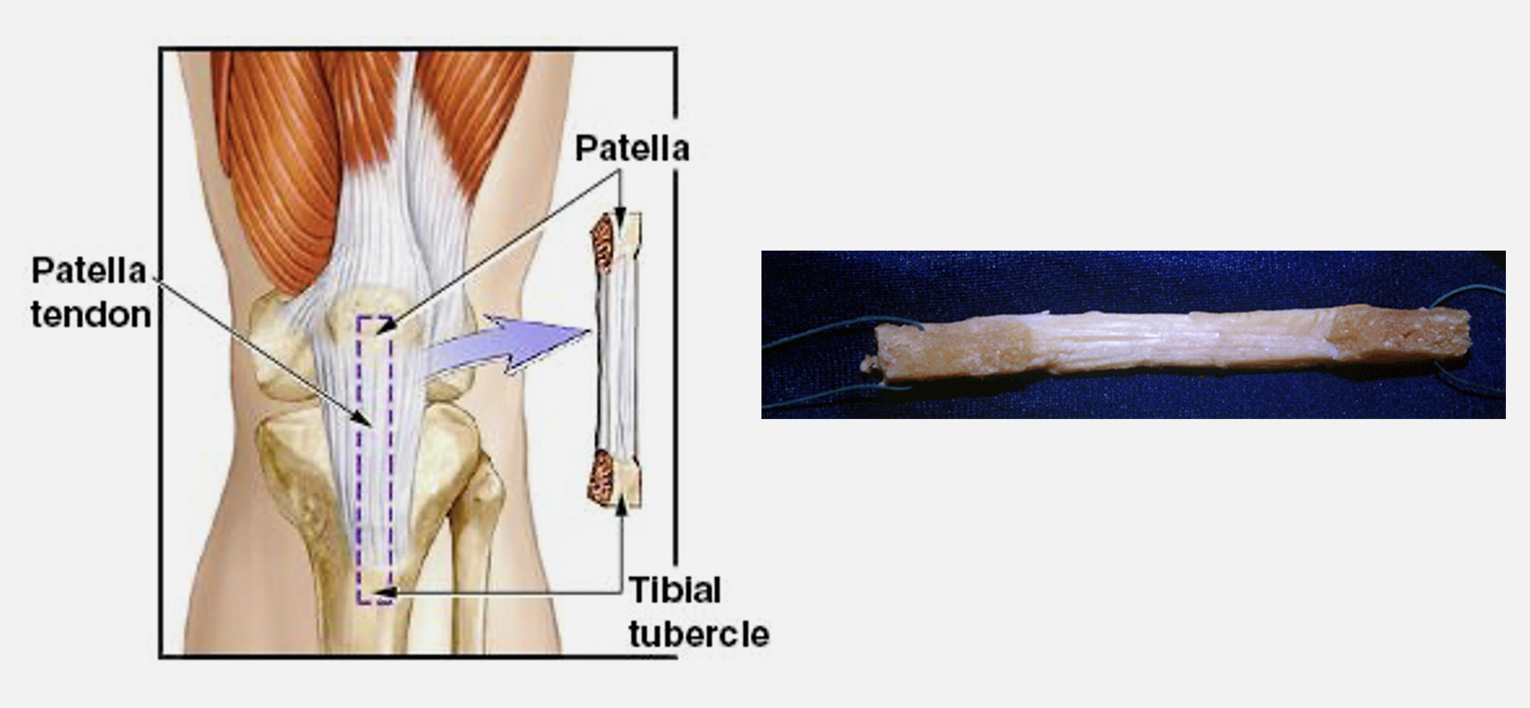 Enxerto Osso-Tendão-Osso