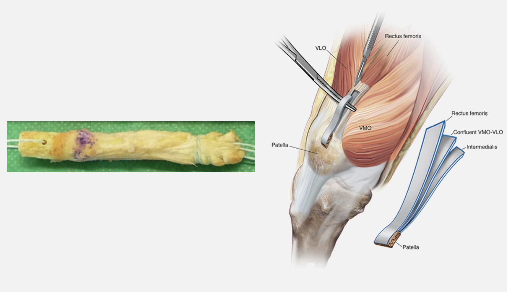 Enxerto Osso-Tendão com tendão Quadricipital